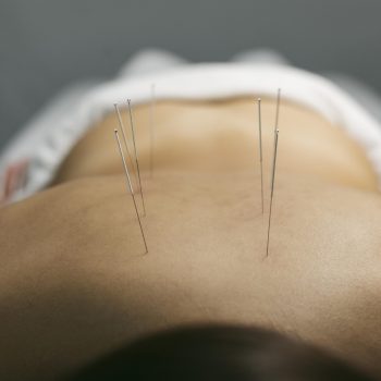 acupuncture-process-client